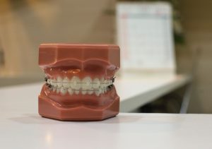 Model teeth with braces applied on table in orthodontist in Glasgow